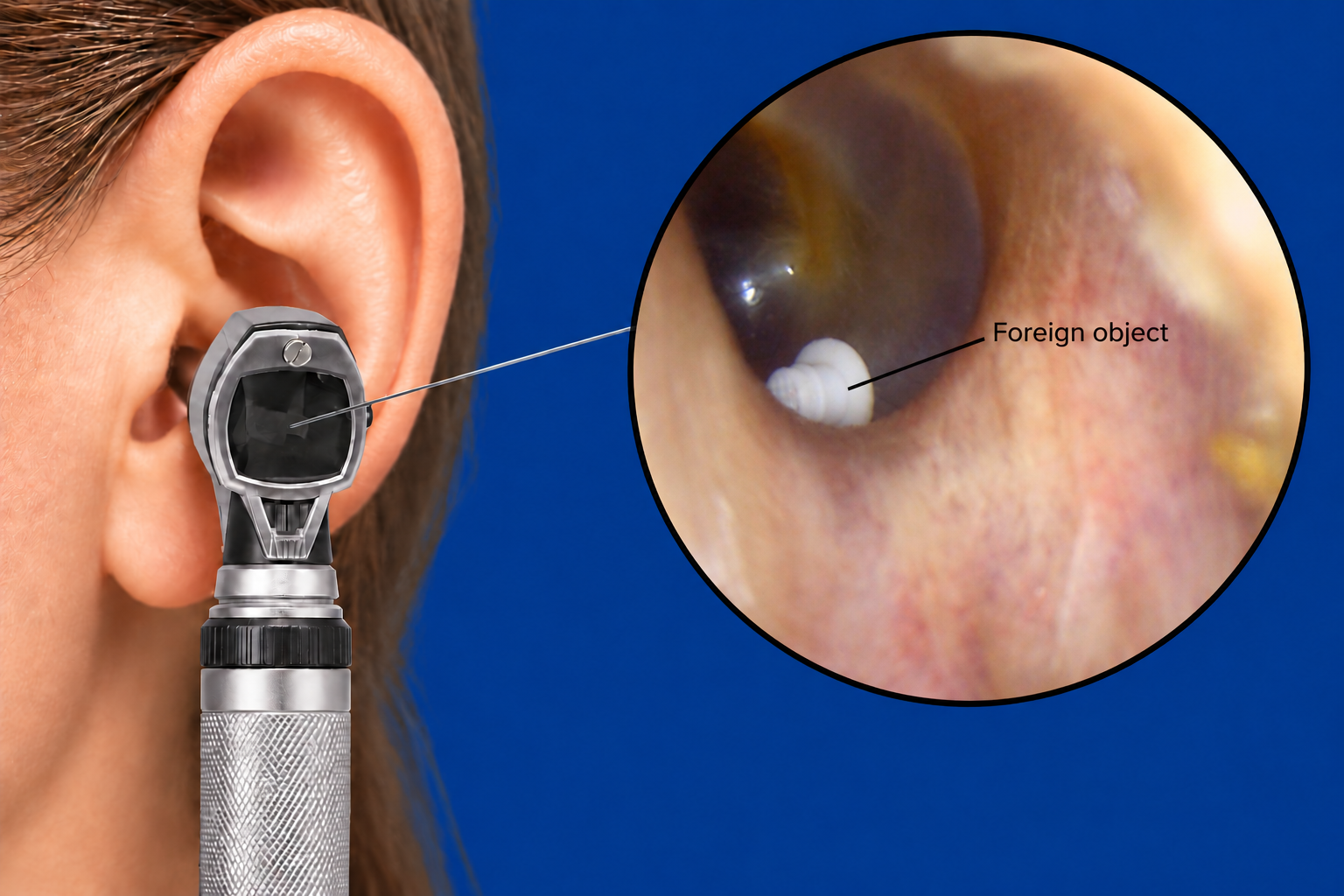 Illustration of a foreign object in the ear